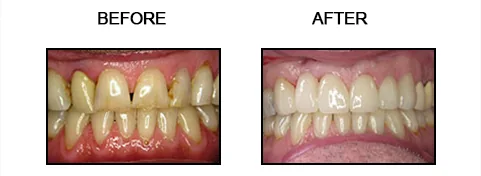 Before and after smile gallery case 5
