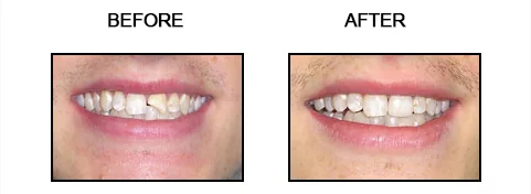 Before and after smile gallery case 6