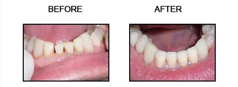 Before and after smile gallery case 7