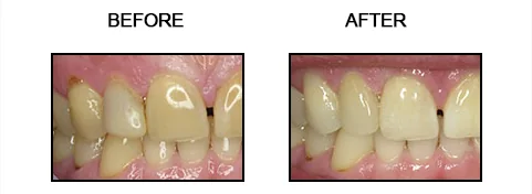 Before and after smile gallery case 9