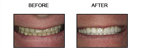 Before and after smile gallery case 11