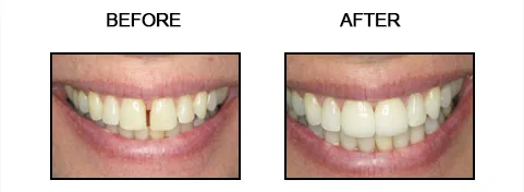 Before and after smile gallery case 12