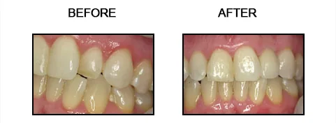 Before and after smile gallery case 13