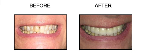 Before and after smile gallery case 14